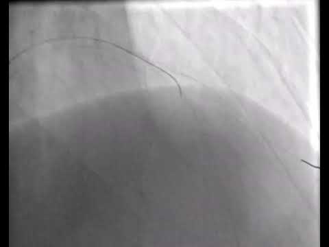 Video 11.1 LAD-diagonal DK mini Culotte stentleme