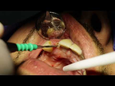 Precision Full Arch Restorations – All-On-X Dental Implants in Los Algodones, Mexico