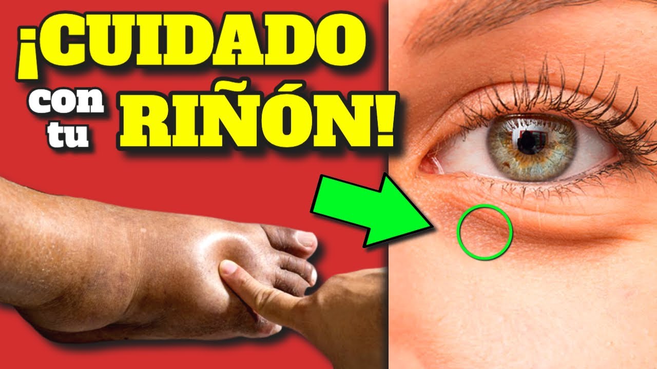¡PELIGRO! ESTOS SÍNTOMAS de ALARMA te avisan QUE TU RIÑÓN te está INTOXICANDO| INSUFICIENCIA RENAL