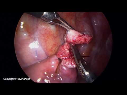 Thoracoscopic Lung Biopsy