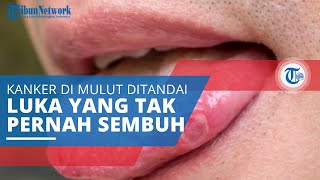 Kanker Lidah, Jenis Kanker yang Mengakibatkan Tumor atau Luka yang Tak Kunjung Sembuh