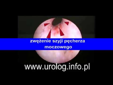 Jak to możliwe, że penis Małe plamki na żołędzi prącia, które jest