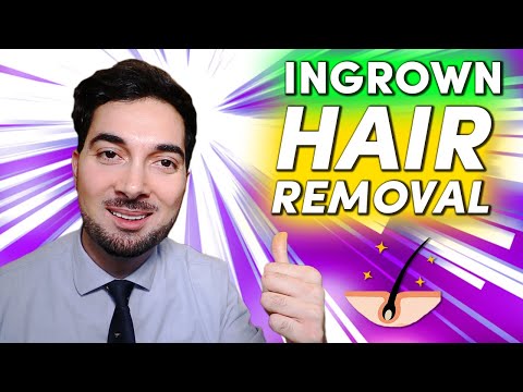 Hemorrhoids treatment at home naturally how to get rid of it