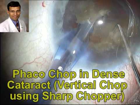 Topical Phaco In Brunescent Cataract