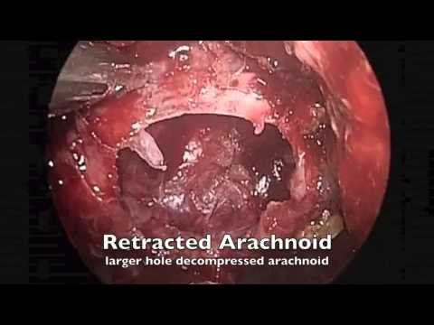 Management of Pin Hole CSF Leak Repair with Nasoseptal Vascularized Flap