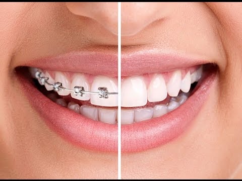 download lagu mp3 mp4 Clear Braces Ahmedabad, download lagu Clear Braces Ahmedabad gratis, unduh video klip Clear Braces Ahmedabad