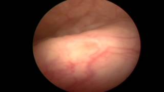 Τυπική Κυστεοσκόπηση