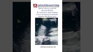 SPLENIC ABSCESS WITH LEFT PLEURAL EFFUSION #drrandhawainstitute #pocus #ultrasound #medicalvideos