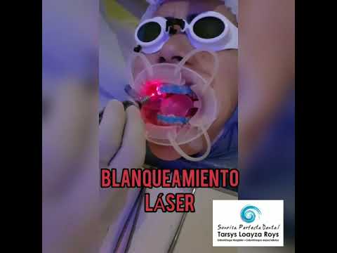 Blanqueamiento dental con láser en Cartagena por la odontóloga Tarsys Loayza Roys