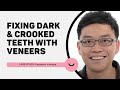 Crooked & Dark Teeth - Joseph'a Smile Makeover