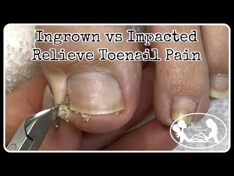 Ingrown Toenail and Impacted Toenail Relief and Prevention