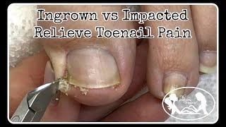 Ingrown Toenail and Impacted Toenail Relief and Prevention
