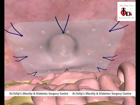 Recurrence of hernia youtube video| Recurrence of Hernia