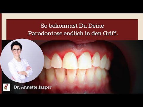 So bekommst Du Deine Parodontose endlich in den Griff.