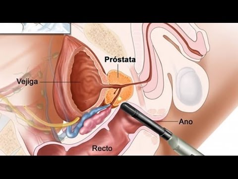 Zalozista gіperplazіya Prostata Prostate Symptome der Prostata bei Männern