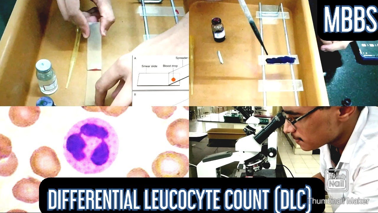 Watch video Differential Leucocyte Count (DLC) Practical | (MUHS) | #mbbs #physiology #hematology Now Differential Leucocyte Count (DLC) Practical | (MUHS) | #mbbs #physiology #hematology