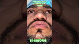 Nose plastic surgery delhi NCR. #rhinoplasty #nosejobs #rhinoplastyspe