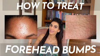 How to Treat Tiny Little Bumps on the Forehead