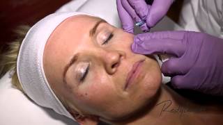 Dr Berne Harmony Program Oslo Azzalure (Botox) Restylane Tear Trough