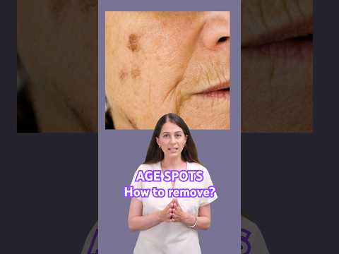 Lentigo and Sun Spots Removal