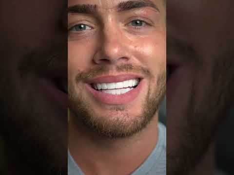 Before and after composite veneers #shorts #veneers