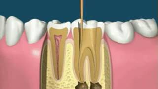 How to replace a dead tooth