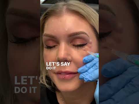 Botox for 11s and Crow's Feet