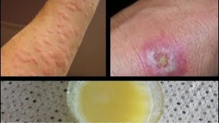 How To Get Rid Of Hives Fast Home Remedy//Allergy fast treatment