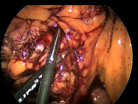 Laparoscopic Extended Right Hemicolectomy with Intracorporeal Anastomosis