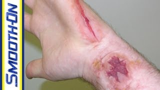 Ultimate Wound Kit Video: