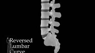 Reversed Lumbar Curve