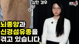 20대 여성이 신경섬유종 뇌종양 겪고 받는 오해와 현실