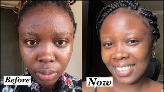 How to achieve Youthful glowing skin . How i cleared tiny bumps/rashes on my face SKINCARE ROUTINE