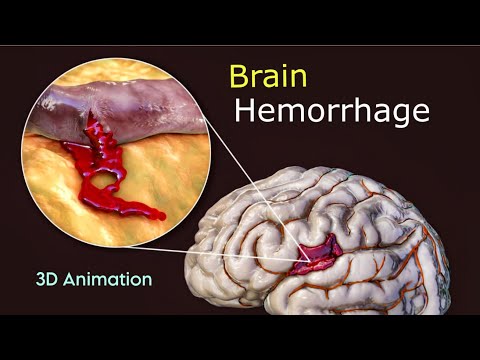 What Triggers Brain Hemorrhage? : 3D Animation | Scopic Vision
