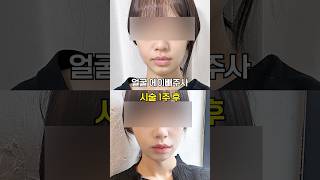 전후차이 실화?