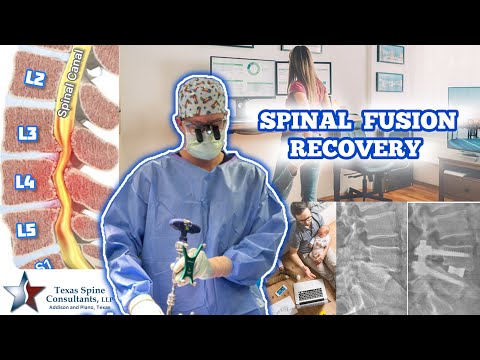 Spinal Fusion Recovery, EXPECTATIONS 🧗‍♀️🏨🏌️🏆