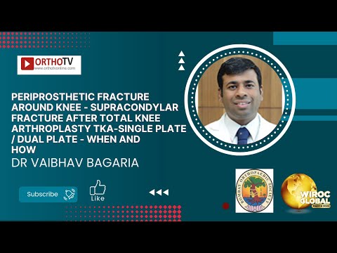 PERIPROSTHETIC fracture afterTKA-Single plate / Dual plate - When andhow - Dr Vaibhav Bagaria