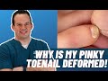 Why Is My Pinky Toenail Thick And Deformed Dr Nick Campitelli
