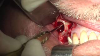 Sinus Lift & Implant Positioning by dr. David Farronato
