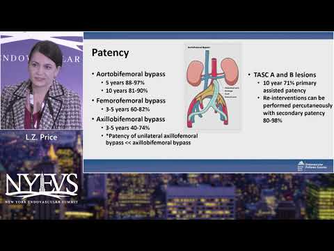 Iliac Artery Revascularization Algorithm, Devices, and Techniques   L  Z  Price   Endo Fellows Sessi
