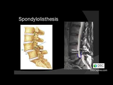Spondylolisthesis, A Serious Spinal Condition: Spondylolisthesis Surgery Specialist Dr. Mark Valente