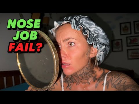 Exposing Nose Jobs In Turkey | Truth And Facts