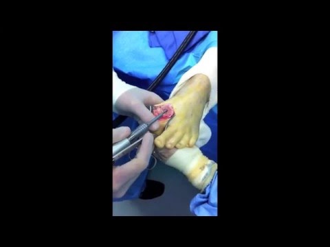 First Big Toe Joint Replacement Surgery with "Primus" Implant 