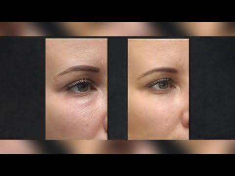 Hijaluronidaza - enzim koji topi hijaluron