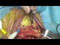 Rectovaginal Fistula Post Low Anterior Tumor Resection Modified Martius Graft Technique
