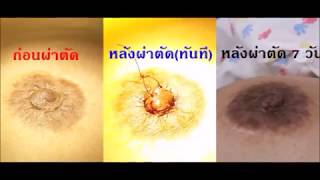 ศัลยกรรมตกแต่งหัวนมให้สวยกว่าเดิม