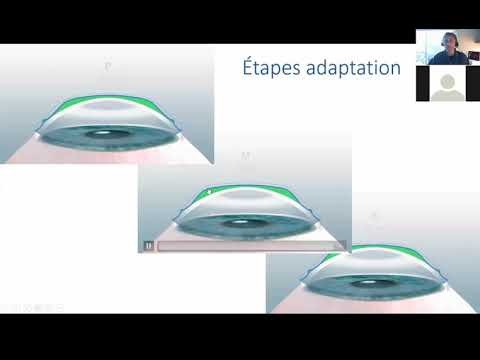 Debuter en Orthokeratologie avec DRL