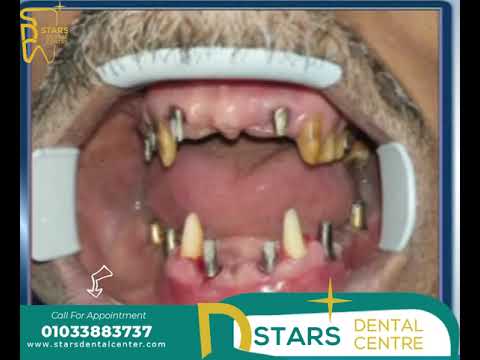حالة زراعة فك كامل داخل مركز Stars Dental Center  مع الدكتور #كريم_مدحت