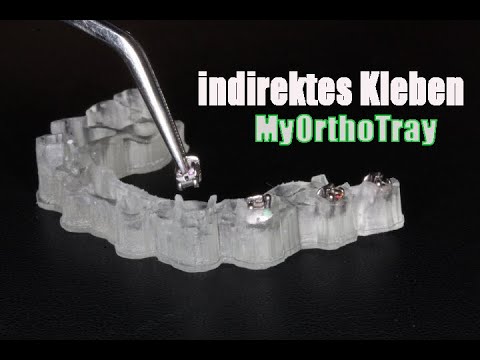 Multiband mit indirect Bonding Tray einsetzen I OeA