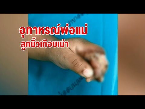 แสงอัลตราไวโอเลตในการรักษาโรคสะเก็ดเงิน 99 ภาพของโรคสะเก็ดเงิน